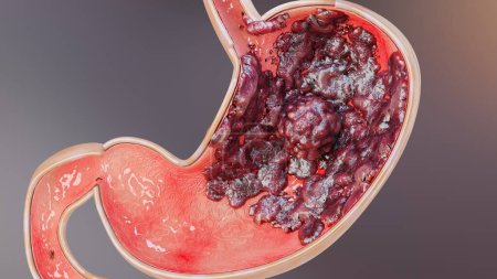 Photo for Stomach cancer. stages tumor growth in digestive system, Peptic Ulcer, Cancer attacking cell. gastric disease concept. symptoms, malignant cancerous, viruses and bacteria, Cross section, 3d render - Royalty Free Image