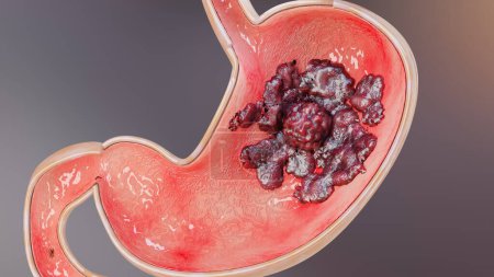 Stomach cancer. stages tumor growth in digestive system, Peptic Ulcer, Cancer attacking cell. gastric disease concept. symptoms, malignant cancerous, viruses and bacteria, Cross section, 3d render