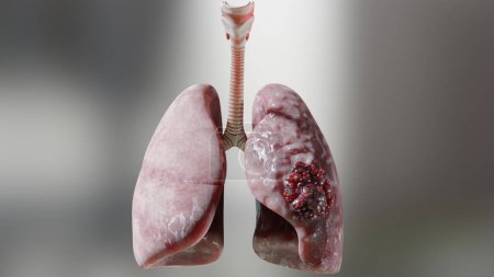 Photo for Pneumonia illness, healthy lungs and disease lungs, Human Lungs cancer, Cigarette smokers Lung disease, cancerous malignant tumor growing and spreading, respiratory system, asthma infection, 3d render - Royalty Free Image