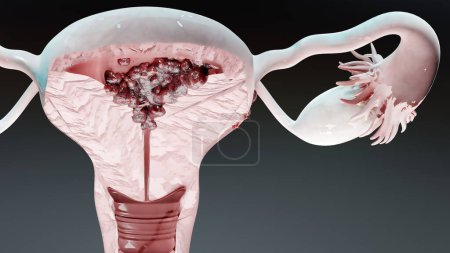 Photo for Reproductive system, cancer cells, ovaries cysts, cervical cancer, growing cells, gynecological disease, metastasis cancerous, duplicating, 3d render - Royalty Free Image