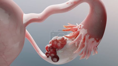 Foto de Tumor maligno ovárico, Anatomía del útero femenino, Sistema reproductivo, células cancerosas, quistes ováricos, cáncer de cuello uterino, células en crecimiento, enfermedad ginecológica, metástasis cancerosas, duplicación, 3d render - Imagen libre de derechos