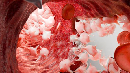 Foto de Hemostasia. Glóbulos rojos y plaquetas en el vaso sanguíneo, vasoconstricción, proceso de cicatrización de heridas. embolias de coágulos de hemorragia, hemofilia. fibrinólisis, coagulación sangrante lesión, renderizado 3d - Imagen libre de derechos