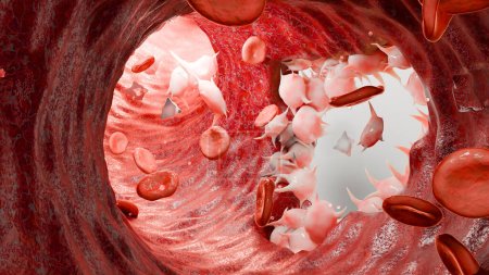 Hämostase. Rote Blutkörperchen und Blutplättchen in den Blutgefäßen, Gefäßverengung, Wundheilung. Blutgerinnsel Embolien, Hämophilie. Fibrinolyse, Verletzung Blutung Gerinnung, 3D-Render