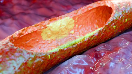 Cholesterrol or Atherosclerotic Plaque in blood vessels, Blocked vessel stroke, Thickened Arteries and Veins, Coronary, fat buildup clogging, Atherosclerosis or atheromatous Hyperlipidemia, 3d render