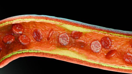 Cholesterrol or Atherosclerotic Plaque in blood vessels, Blocked vessel stroke, Thickened Arteries and Veins, Coronary, fat buildup clogging, Atherosclerosis or atheromatous Hyperlipidemia, 3d render