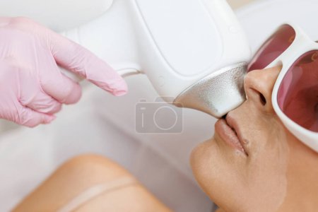 Photo for The cosmetologist does the procedure for laser hair removal of unwanted hair of the face to a young girl in a beauty salon. Dermatology, photorejuvenation. Cosmetic clinic - Royalty Free Image