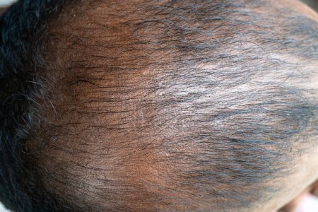 Foto de Cabeza calva de un hombre adulto por la espalda. Alopecia en la cabeza. Cabeza calva de un hombre asiático negro. Pérdida de cabello en hombres - Imagen libre de derechos