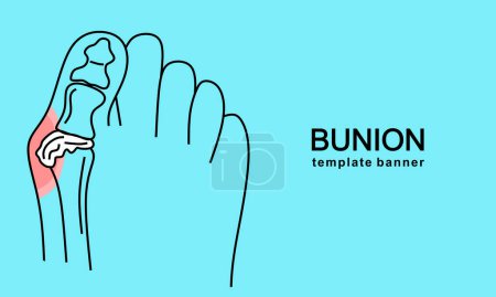 Illustration for Bunion in foot Template banner. Abstract minimal illustration of foot with red spot on hallux suffers from pain. Design template for medicine or therapy for valgus deformity or bunion - Royalty Free Image