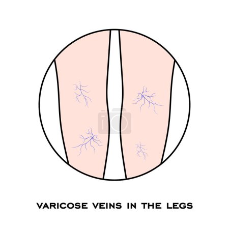 Illustration for Varicose veins in the legs - Royalty Free Image