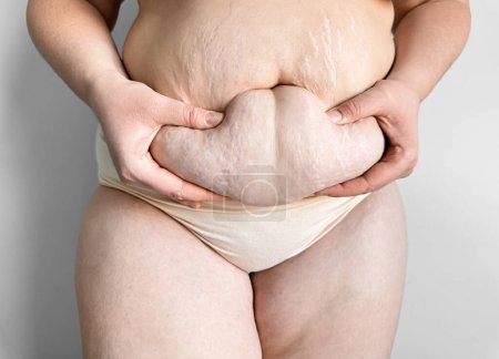 Primer plano del vientre posparto con estrías sostenidas por las manos. El cuerpo de las mujeres reales, los cambios de maternidad y el concepto de autoaceptación. Foto de alta calidad