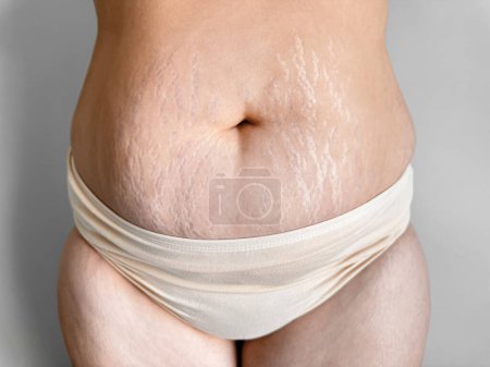 Photo for Womans midsection with stretch marks to celebrate real beauty, body positivity, and the natural changes after childbirth. The concept of self love and naturalness. High quality photo - Royalty Free Image