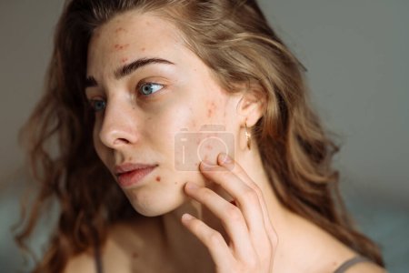 Téléchargez les photos : Jeune femme touchant un bouton sur son visage, se sentant ennuyée à cause de problèmes avec la peau. Dermatologie, cosmétologie, soins de la peau. - en image libre de droit