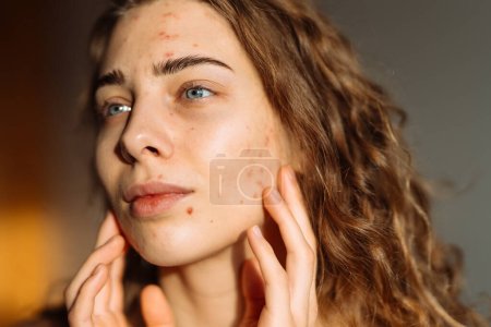Téléchargez les photos : Jeune femme touchant un bouton sur son visage, se sentant ennuyée à cause de problèmes avec la peau. Dermatologie, cosmétologie, soins de la peau. - en image libre de droit