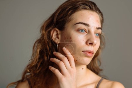 Junge Frau mit Problemhaut. Behandlung von Akne. Dermatologie, Kosmetologie, Hautpflege.