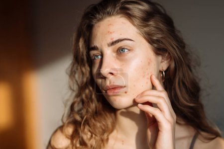 Téléchargez les photos : Jeune femme avec un problème de peau. Traitement de l'acné. Dermatologie, cosmétologie, soins de la peau. - en image libre de droit