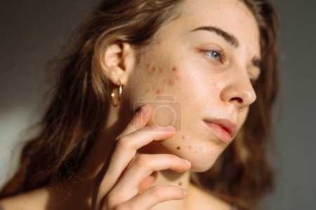 Téléchargez les photos : Jeune femme avec un problème de peau. Traitement de l'acné. Dermatologie, cosmétologie, soins de la peau. - en image libre de droit