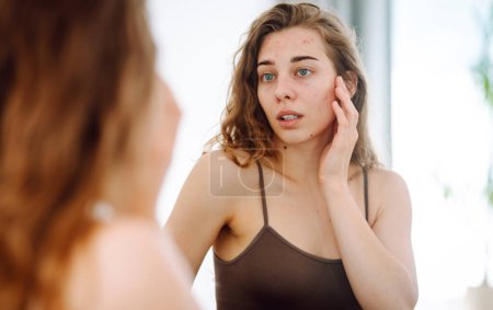 Young woman with pimples on her face. Life with acne. Problem skin prone to rashes and acne, scars. Dermatology and cosmetology concept. Allergy concept. 
