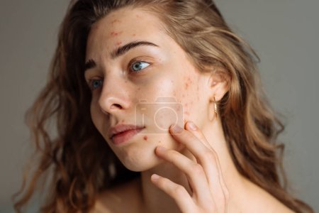 Retrato de una joven con piel problemática. Espinillas en la cara. Cuidado facial de la piel. Problema del acné.
