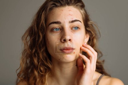 Portrait of a young girl with problem skin. Pimples on the face. Facial skin care. Acne problem.