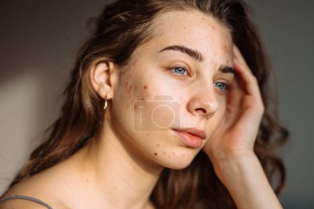 Portrait of a young girl with problem skin. Pimples on the face. Facial skin care. Acne problem.