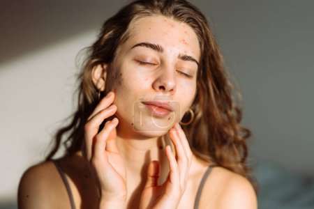 Retrato de una joven con piel problemática. Espinillas en la cara. Cuidado facial de la piel. Problema del acné.