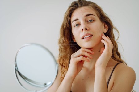Portrait of a young girl with problem skin looks in the mirror. Pimples on the face. Facial skin care. Acne problem.