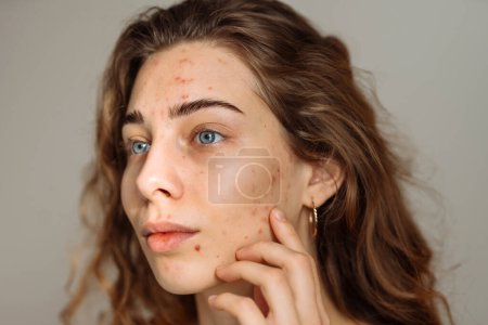 Foto de Mujer joven con problemas de acné. Dermatología, cosmetología, cuidado de la piel. Piel natural. - Imagen libre de derechos