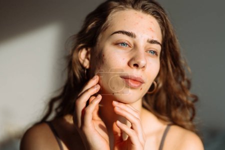Foto de Mujer joven con problemas de acné. Dermatología, cosmetología, cuidado de la piel. Piel natural. - Imagen libre de derechos