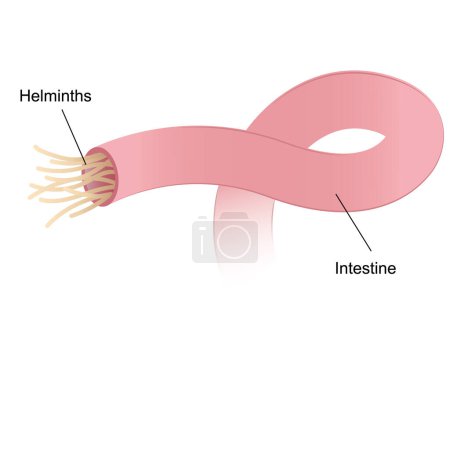 Illustration for Illustration of internal human parasites, roundworm or hookworm in the small intestine - Royalty Free Image