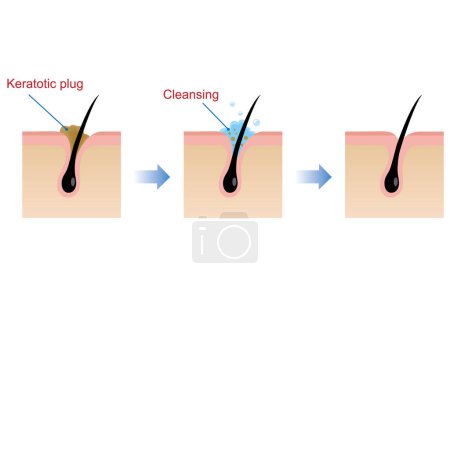 Illustration for Structure illustration of pores Clear keratotic plug (whiteheads ,blackheads ) with cleansing. - Royalty Free Image