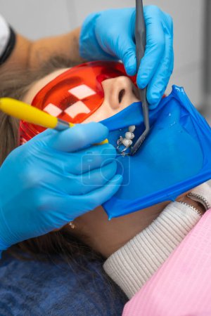Photo for Close-up dentist's hands place the filling material into the patient's tooth with a dental spatula. Treatment, restoration of the chewing surface of the teeth of a young woman. Vertical photo - Royalty Free Image