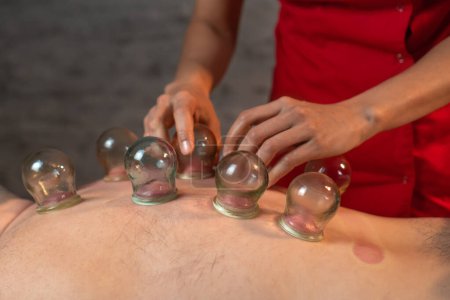 Photo for Close-up of the masseur's hands placing glass jars on the man's back. Massage with glass vacuum jars. Close-up of a man lying with cans on his back in a spa. Vacuum therapy. Massage with jars. - Royalty Free Image