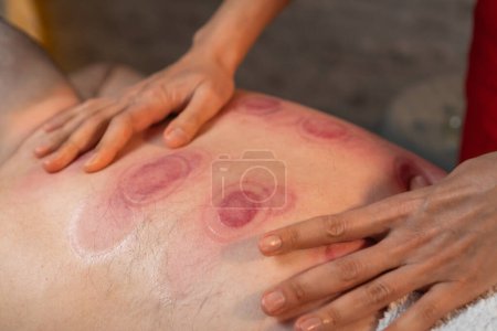 Masseur massiert den Rücken des Mannes mit Spuren nach Schröpfung Vakuum-Therapie. Nahaufnahme der Hände und des Rückens des Masseurs mit Spuren nach der Vakuummassage