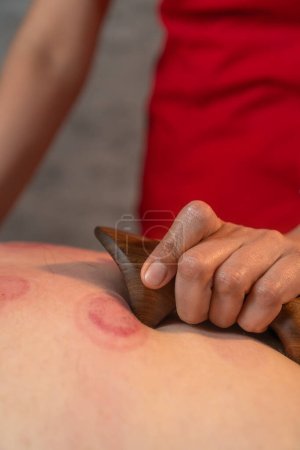Nahaufnahme eines Masseurs, der den Rücken eines Mannes nach einer Vakuum-Schröpftherapie mit einem Holzwerkzeug, einem Schaber, restauriert. Vertikales Foto