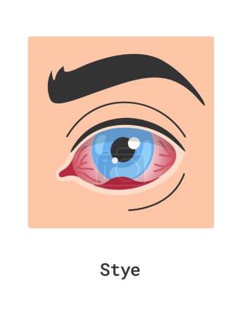 Illustration for Stye Human Eye Disease Vector Illustration - Royalty Free Image