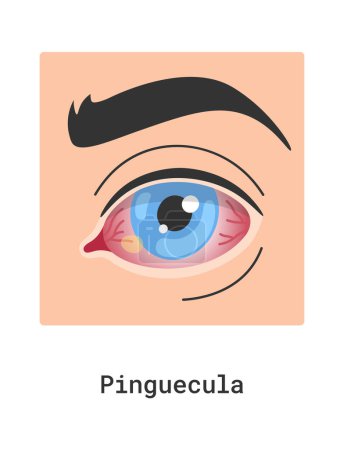 Téléchargez les illustrations : Illustration vectorielle de la maladie oculaire humaine de Pinguecula - en licence libre de droit