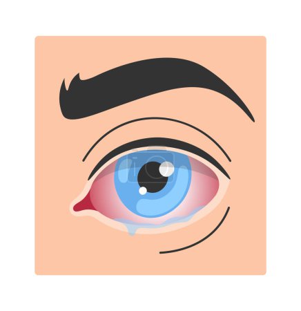 Illustration for Keratitis Human Eye Disease Vector Illustration - Royalty Free Image