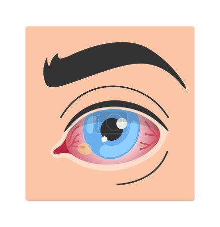Téléchargez les illustrations : Illustration vectorielle de la maladie oculaire humaine de Pinguecula - en licence libre de droit