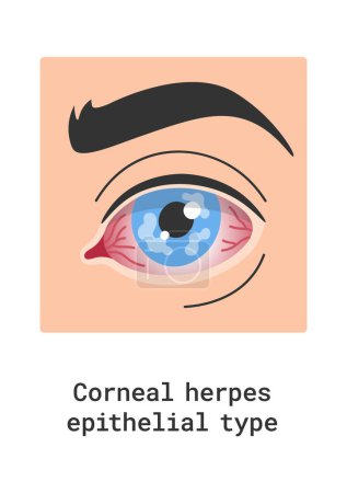 Ilustración de Herpes corneal Epithelial Eye Disease Vector Illustration - Imagen libre de derechos