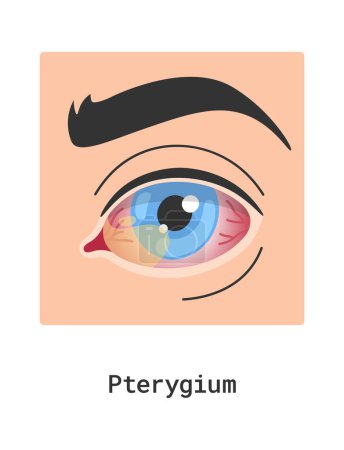 Téléchargez les illustrations : Illustration vectorielle de la maladie oculaire humaine de Pterygium - en licence libre de droit