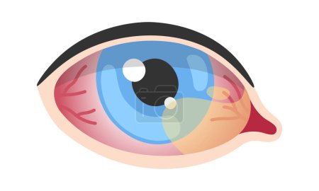 Téléchargez les illustrations : Illustration vectorielle de la maladie oculaire humaine de Pterygium - en licence libre de droit