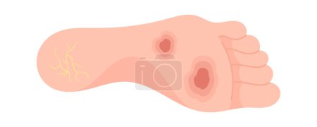 Illustration vectorielle des symptômes du pied diabétique