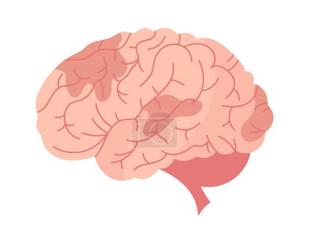 Ilustración de Enfermedad cerebral cerebrovascular Vector Ilustración - Imagen libre de derechos