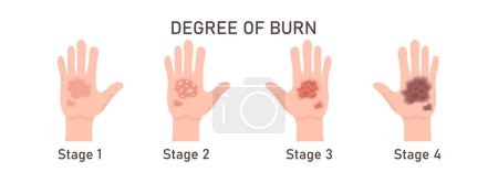 Illustration for Degree Of Skin Burn Vector Illustration - Royalty Free Image
