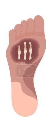 Téléchargez les illustrations : Illustration vectorielle de la maladie du gangrène du pied entier - en licence libre de droit