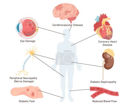Les complications de la maladie du diabète ont affecté les organes humains isolés ensemble médical sur fond blanc. Illustration vectorielle de la silhouette humaine et des lésions oculaires, cérébrales, cardiaques, nerveuses, rénales, plantaires, artérielles