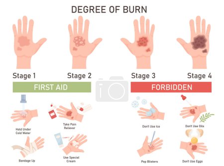 Illustration for Four degree of skin burn with different damage and injury medical guide infographic poster. First aid and wound treatment instruction, forbidden action to avoid worsening vector illustration - Royalty Free Image
