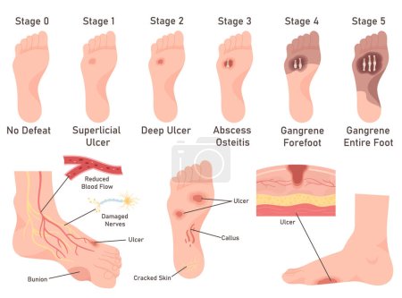 Enfermedades del pie diabéticas síntomas etapa póster infografía médica. Ilustración vectorial de pierna humana sin derrota, inflamación, úlcera, dolor de piel con abceso, gangrena. Concepto de salud y medicien