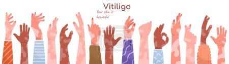 Verschiedene menschliche Hände mit Vitiligo Depigmentierung Dermatologie Krankheit gesetzt Vektor Illustration. Männliche und weibliche Arme mit genetischen Hauterkrankungen Designelemente für das weltweite Problembewusstsein-Poster