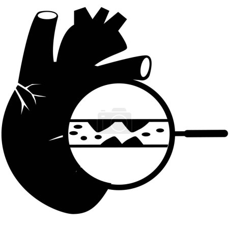 Ilustración de Colesterol en los vasos sanguíneos humanos y el icono del corazón. Señal de alto nivel. Símbolo de arterias bloqueadas. Logo de ataque al corazón. Concepto de infarto de miocardio. estilo plano. - Imagen libre de derechos